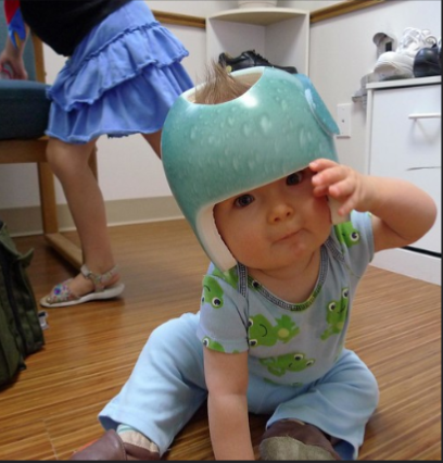 Image of a male infant wearing a cranial remodeling orthosis